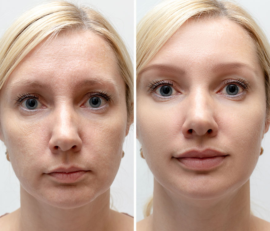 woman face wrinkles before and after